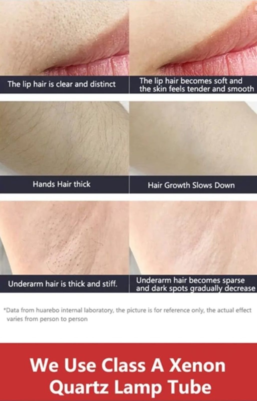 Ice Cooling IPL Hair Removal Device